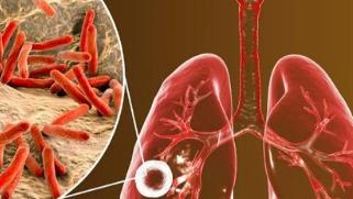 CAPACITACION EN TUBERCULOSIS PULMONAR Y EXTRAPULMONAR